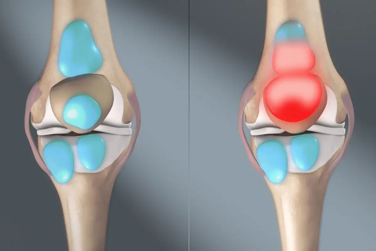 A medical illustration of a healthy and an inflamed knee joint.