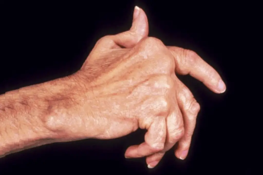 One hand with Arthritis.