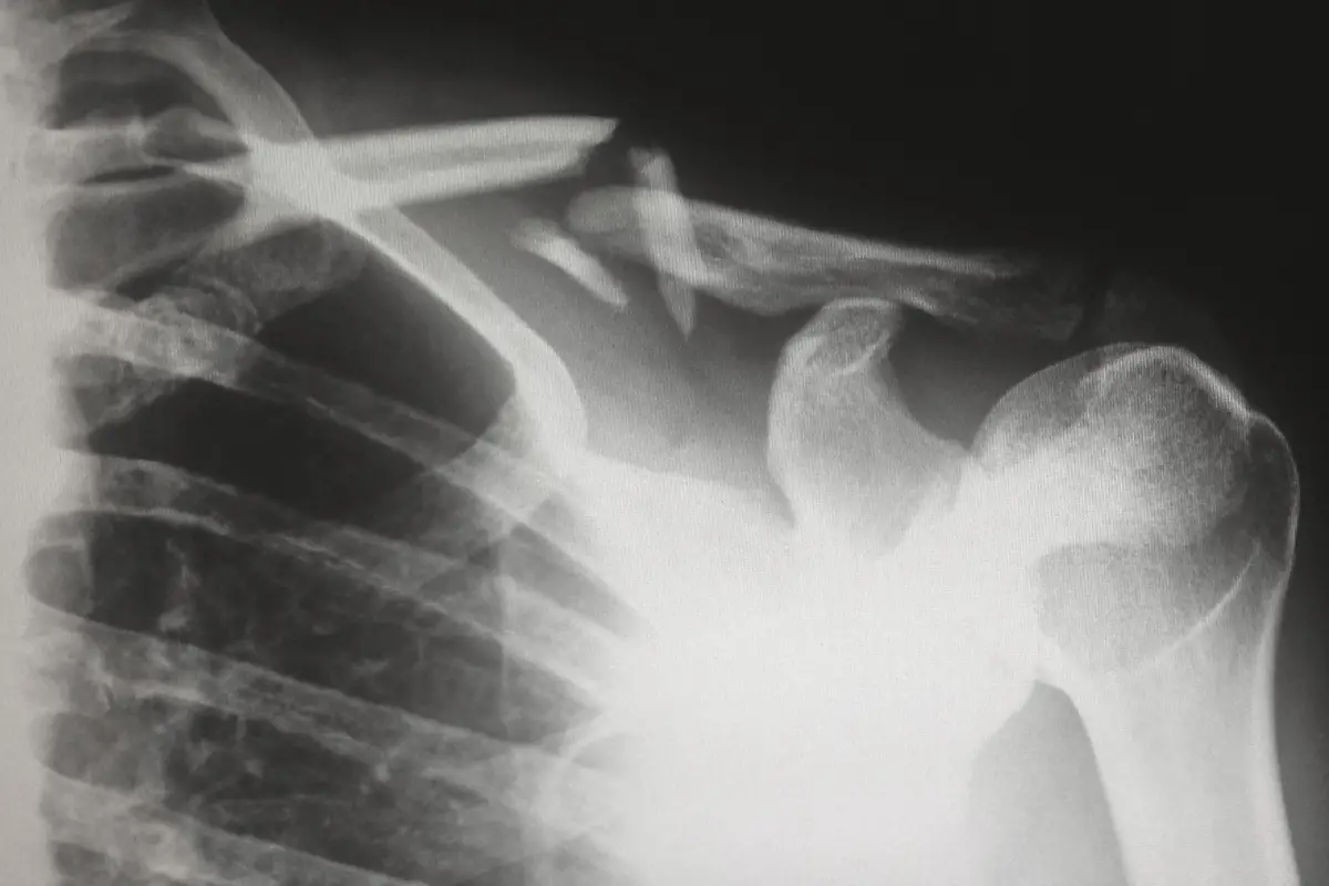 A black and white X-ray image of a human shoulder with no fractures or abnormalities. Herbal Remedy Broken Bones