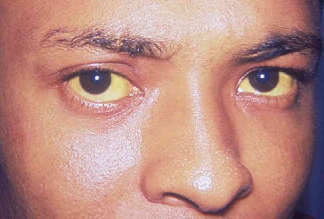 A close-up of a person’s eye with a noticeable yellow tint in the sclera, indicative of jaundice.