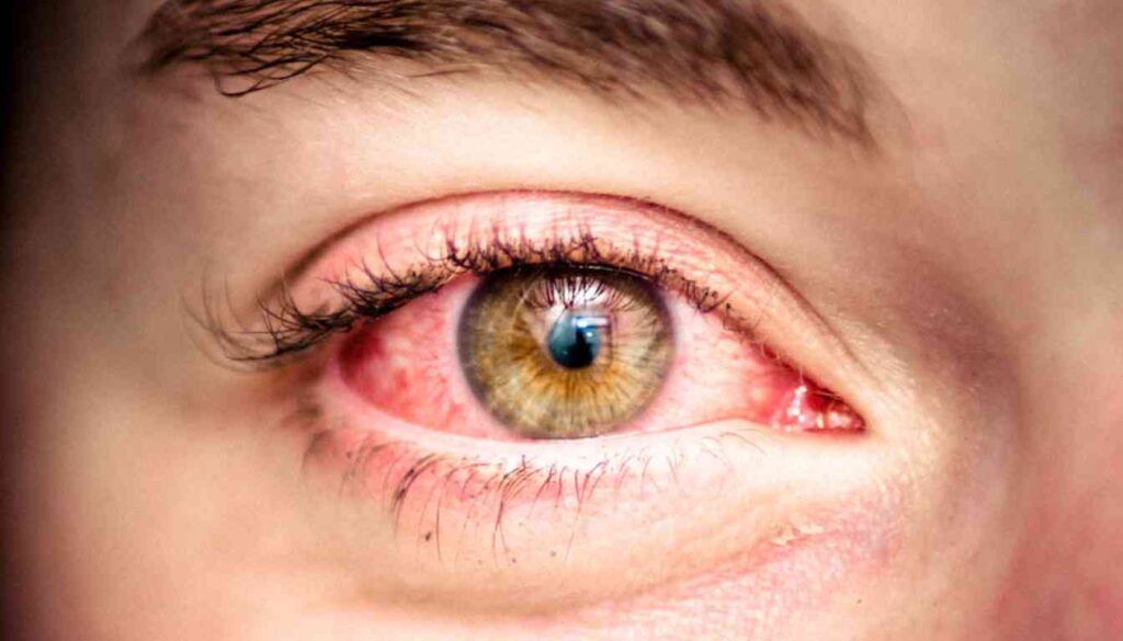 Close-up of a human eye with noticeable redness and irritation.