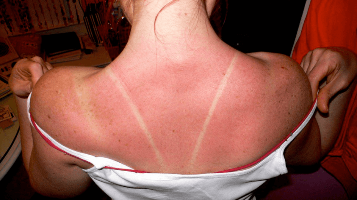 A person with sunburn on their back and shoulders.