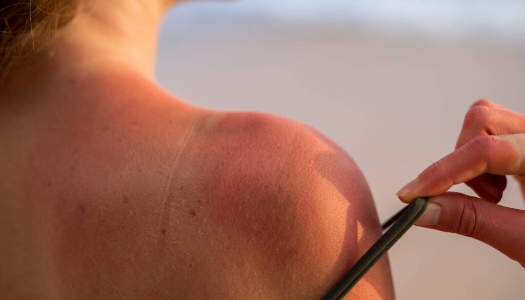 Close-up of a person’s sunburned shoulder with a hand pulling down a strap, revealing a tan line.