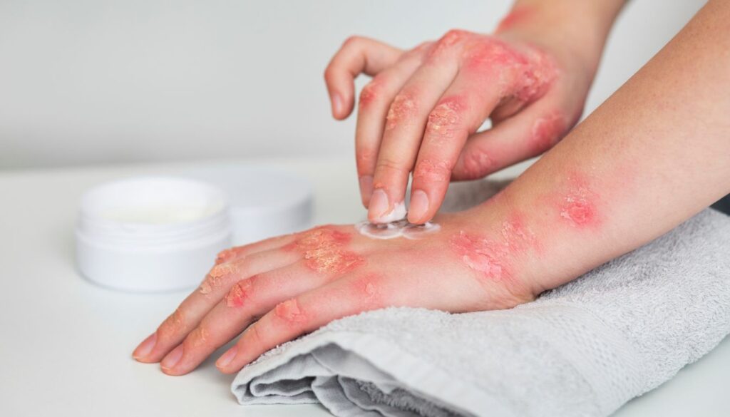 A person applying a soothing natural cream to red, irritated eczema patches on their hand, with a jar of cream and fresh herbs in the background.