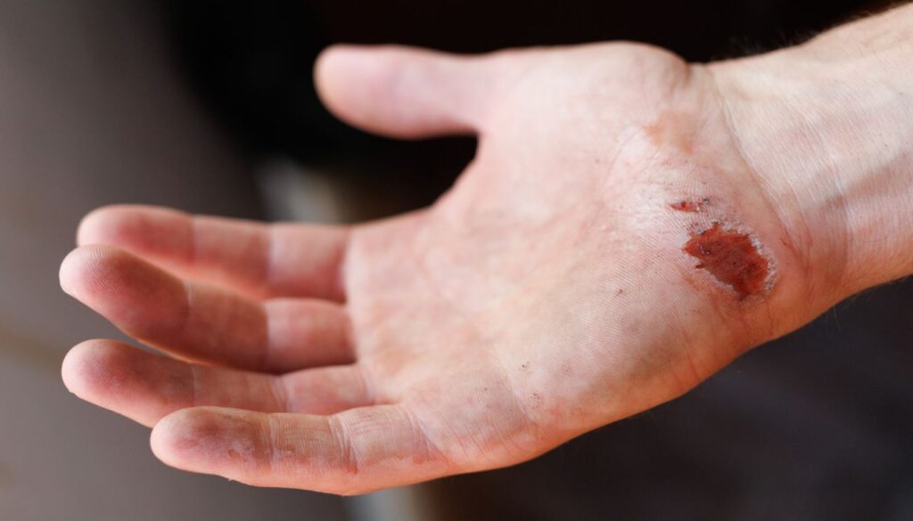 An open hand with a visible wound on the palm, showing dried blood and abrasions, with traces of dirt on the skin.