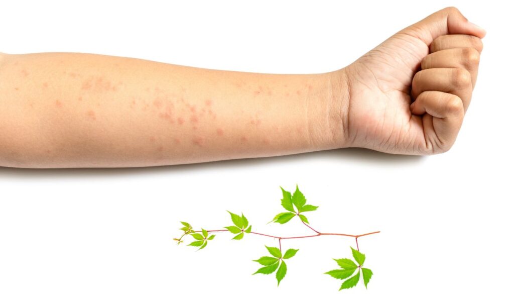 A person applying a soothing home remedy to a poison ivy rash, focusing on natural relief and healing.