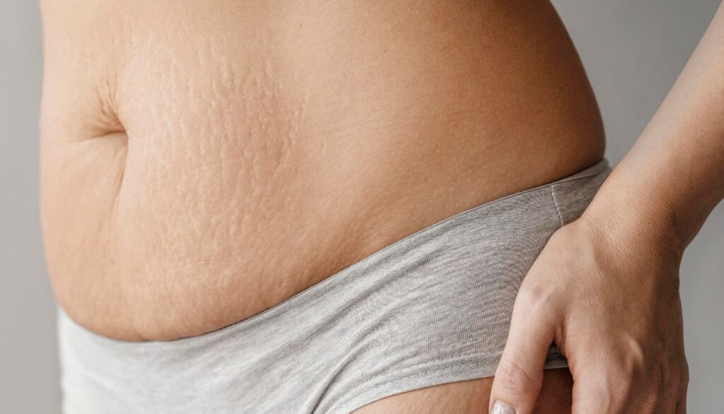 Close-up of a person's abdomen with visible stretch marks, wearing grey underwear.